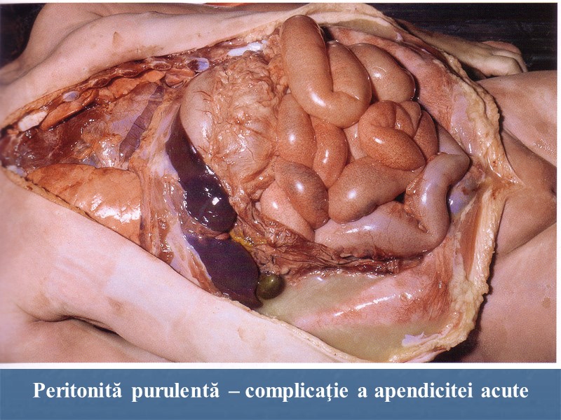 Peritonită purulentă – complicaţie a apendicitei acute